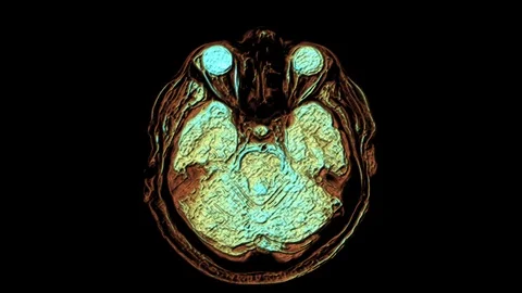 Bulk multicolored MRI scans of the brain and head to detect tumors. Diagnostic Stock Footage 122943964