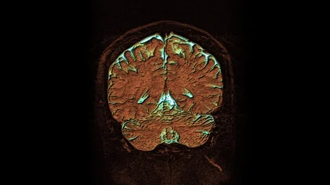 Bulk multicolored MRI scans of the brain and head to detect tumors. Diagnostic Stock Footage 122944070