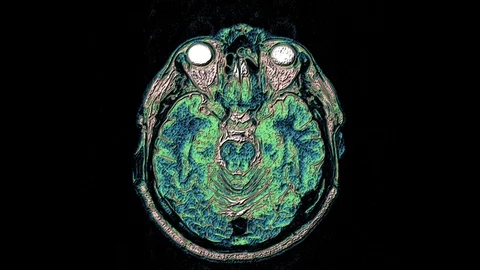 Bulk multicolored MRI scans of the brain and head to detect tumors. Diagnostic Stock Footage 122944222