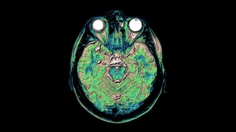 Bulk multicolored MRI scans of the brain and head to detect tumors. Diagnostic Stock Footage 123089923