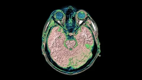 Bulk multicolored MRI scans of the brain and head to detect tumors. Diagnostic Stock Footage 123857670