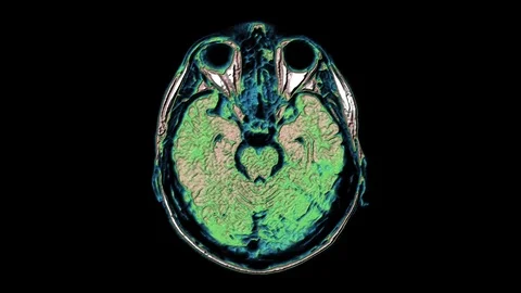 Bulk multicolored MRI scans of the brain and head to detect tumors. Diagnostic Stock Footage 124078049