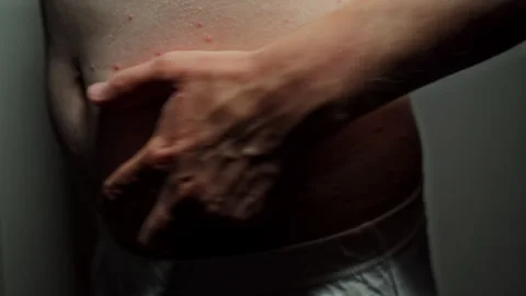 Bumps from Hell - Unbearable itching. Man's Excruciating Itch, Suspecting Stock Footage 244704003