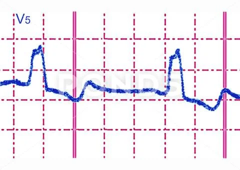 Bundle Branch Block, Ecg Incomplete Bundle Branch Block: Transmission 