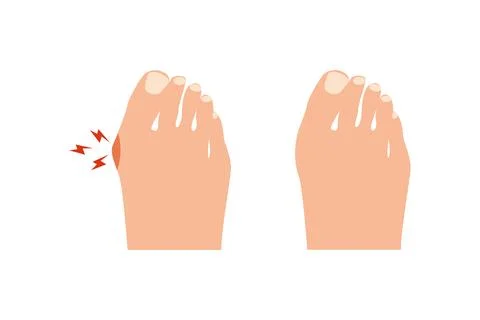 Bunion before and after operation. Vector illustration. Illustrazione stock