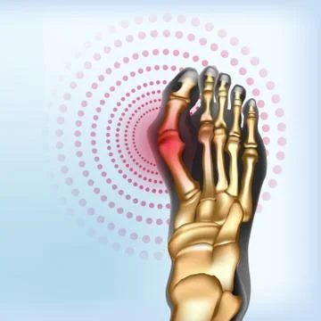 Bunion Foot deformation Realistic bones of foot Stock Illustration
