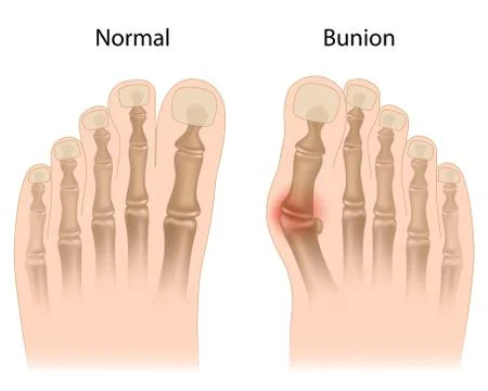 Bunion in foot Stock Illustration