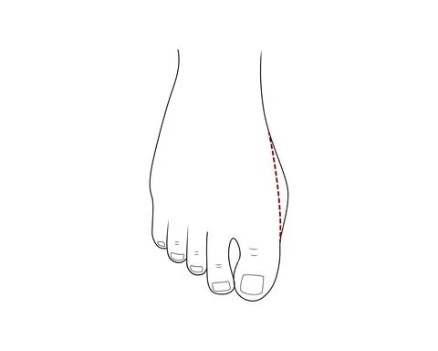 Bunion foot problem vector illustration outline design. Stock Illustration