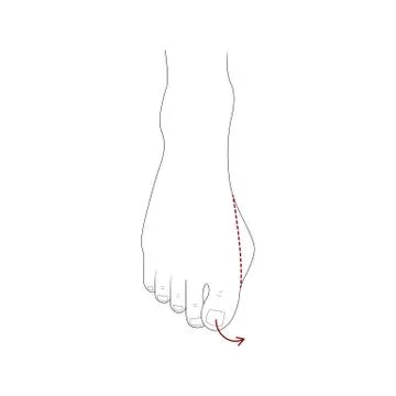 Bunion surgery correction Stock Illustration