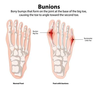 Bunions: Normal vs. Affected Foot Stock Illustration
