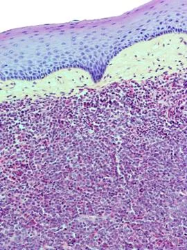 Burkitts lymphoma, light micrograph 스톡 사진