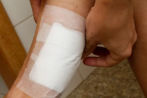 Burn back of Leg Stock Photos