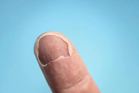 Burn on finger, biometrics problems concept. In the photo, the real fingerprint Fotos de archivo