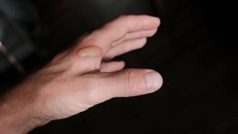 Burn of the hand Stock Footage 247456434