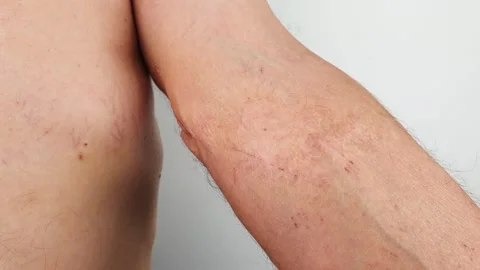 Burn scars, burn scars on the arm. Stock-Footage 245933569