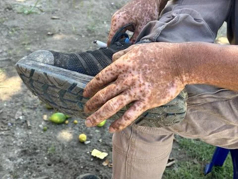 Burn scars Stock Photos