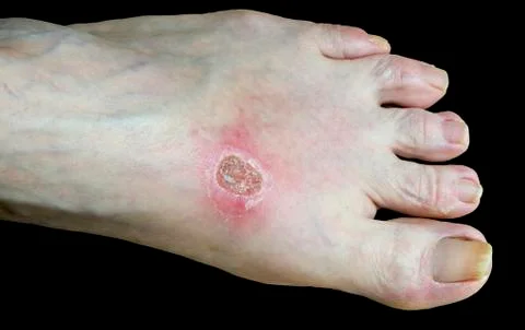 Burned foot Stock Photos