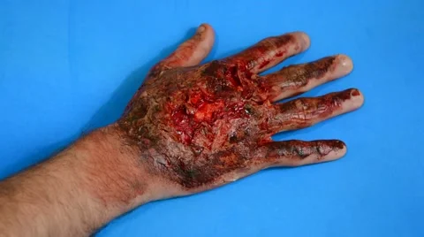 Burned hand 3 in blue screen Stock Footage 50667438