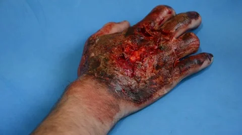 Burned hand in blue screen Stock Footage 50667643