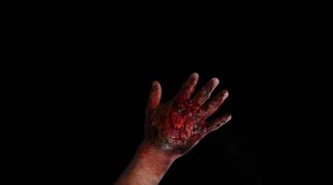 Burned hand Stock Footage 50667136