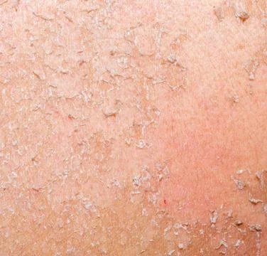 Burned skin macro Stock Photos