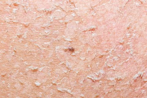 Burned skin macro Stock Photos