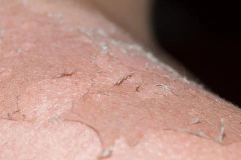 Burned skin macro Stock Photos