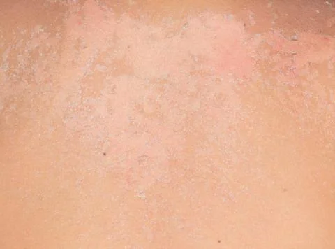 Burned skin macro Stock Photos