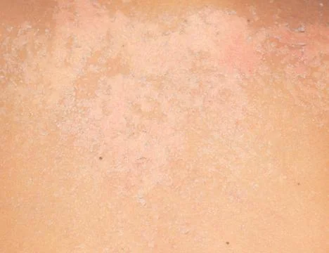 Burned skin macro Stock Photos