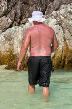 Burning man smeared with sunscreen backdrop of rocks. Stock Photos