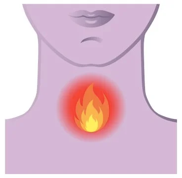 Burning throat Stock Illustration