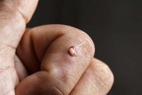Burns 스톡 사진