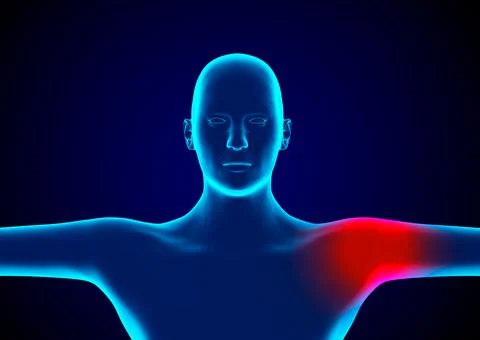 Bursitis is an inflammation of bursae, small pockets that lie between bones, Stock Illustration