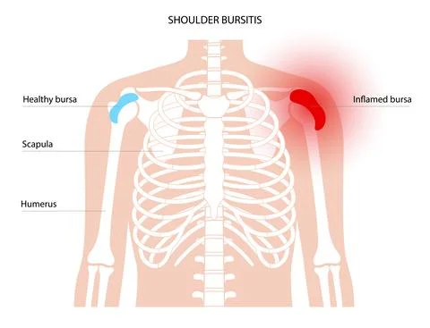Bursitis inflammation concept Stock Illustration