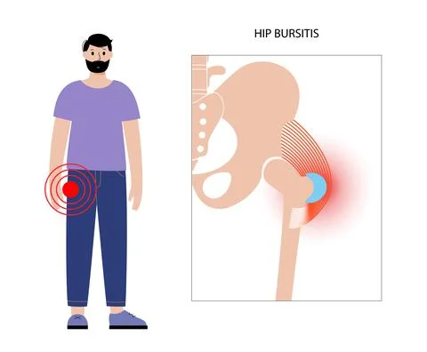 Bursitis inflammation concept Illustrazione stock