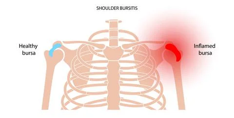 Bursitis inflammation concept Stock Illustration