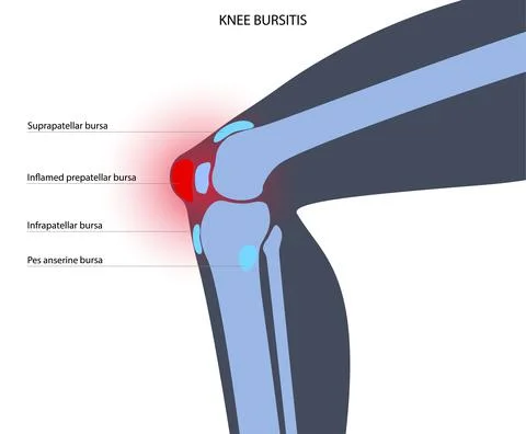 Bursitis inflammation concept Illustrazione stock