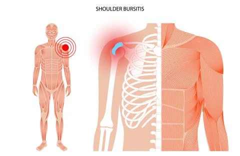 Bursitis inflammation concept Stock Illustration