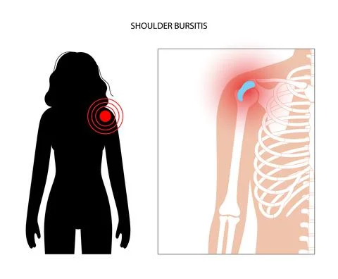 Bursitis inflammation concept Stock Illustration