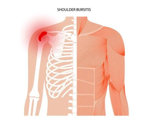 Bursitis inflammation concept Stock Illustration