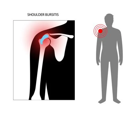 Bursitis inflammation concept Stock Illustration