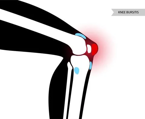 Bursitis inflammation concept Stock Illustration