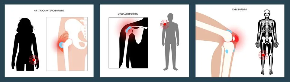 Bursitis inflammation concept Stock Illustration
