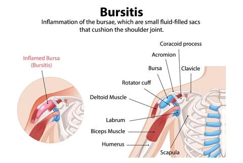 Bursitis in the Shoulder Joint Stock Illustration