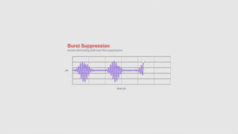 Burst Suppression EEG Brain Wave Animation Labeled Video Overlay Alpha 4K Видео 339303728