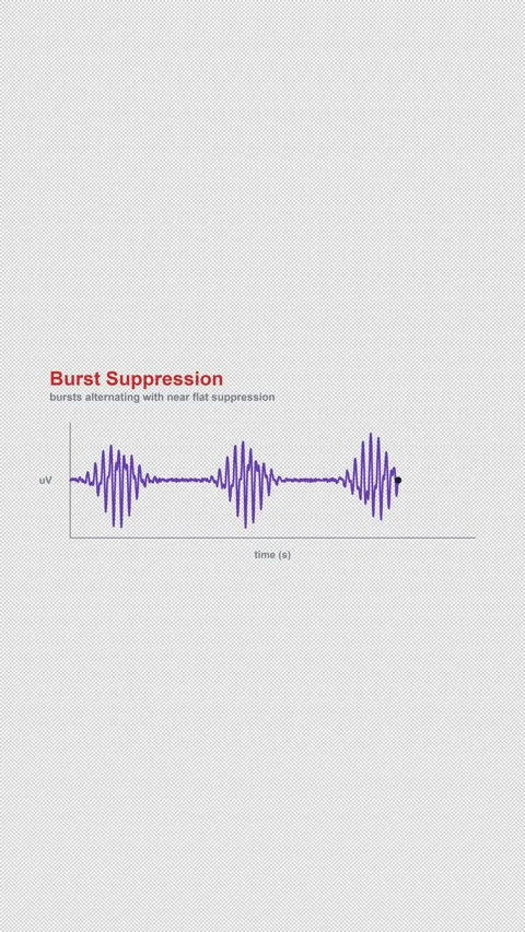 Burst Suppression Labeled EEG Brain Wave Alpha 4K Vertical 9x16 Light Видео 339493899