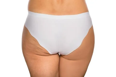 Buttocks with cellulite and without cellulite Stock Photos