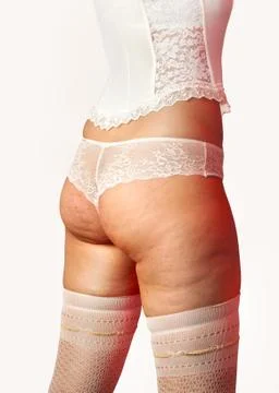 Buttocks with cellulite Stock Photos