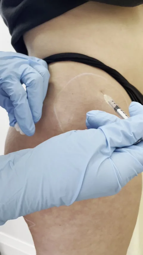 Buttocks Fat Reduction Injection 4K Aesthetic Procedure Close-Up 2 Stock Footage 310480885