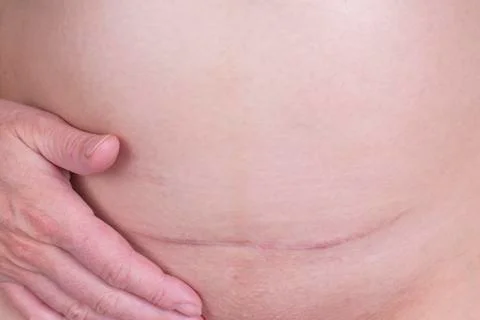 C section scar Stock Photos